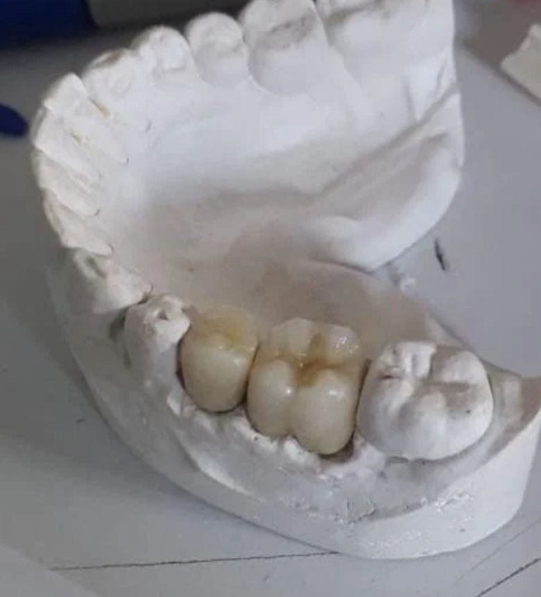 Reparaciones y correcciones de coronas 