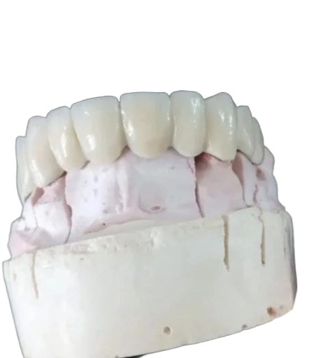 Corona metal porcelana 