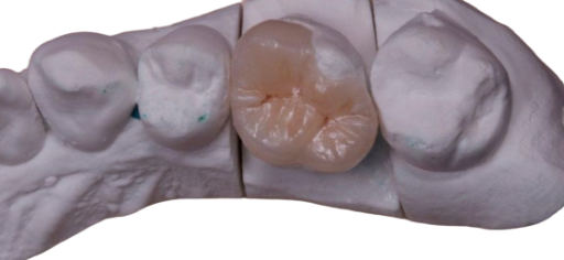 Incrustaciones y carillas en  silicato de litio 