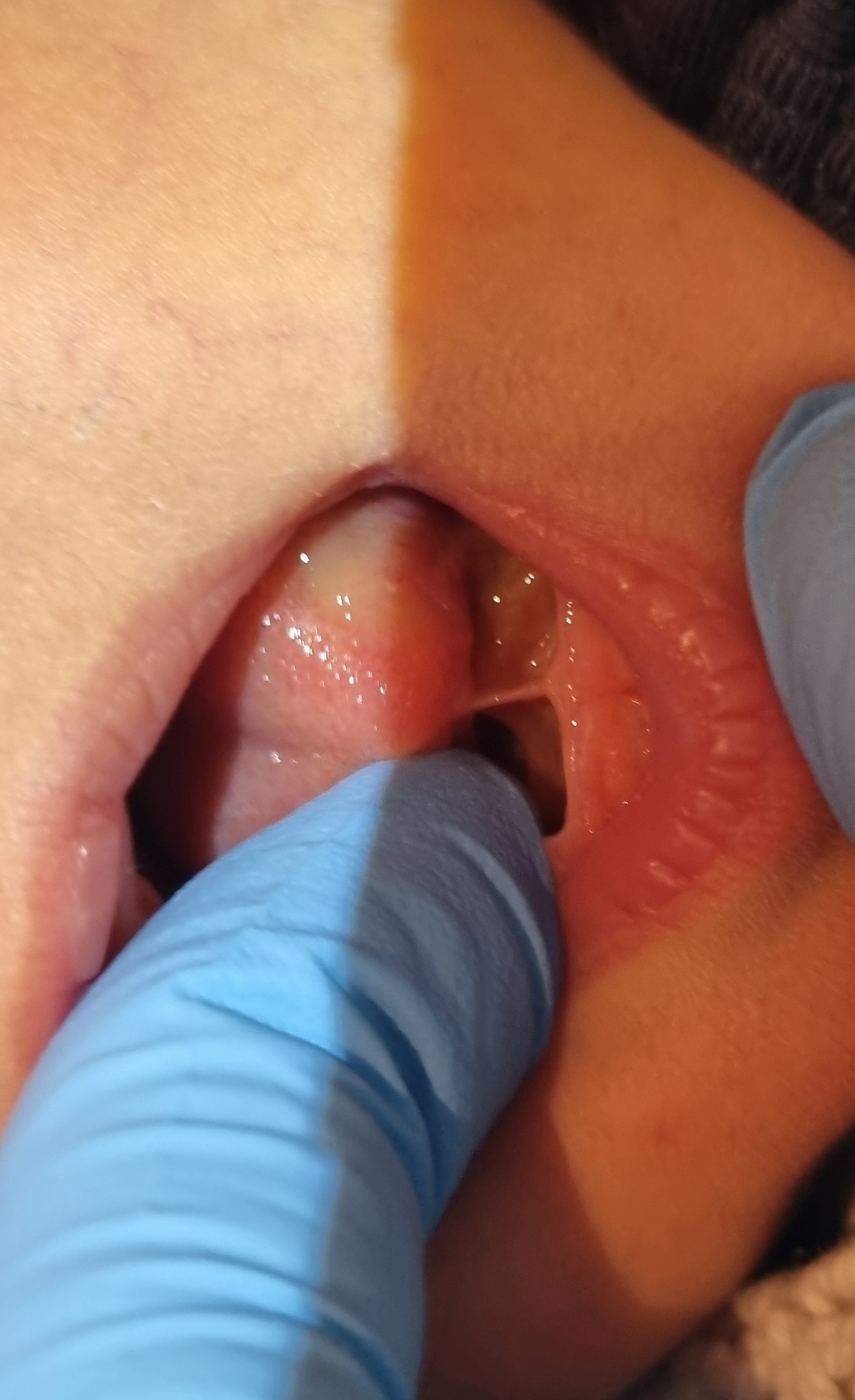 Tongue Tie Assessment