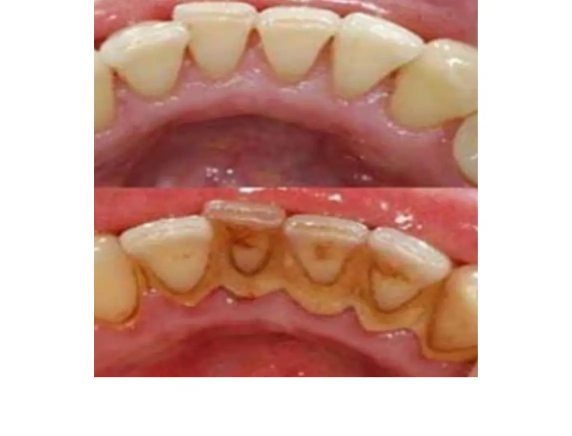 Teeth cleaning and polishing