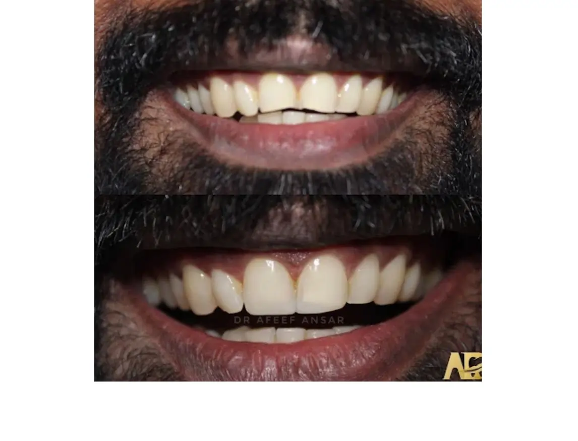 Broken tooth correction