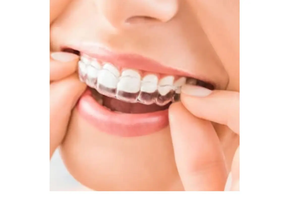 Clear Aligners