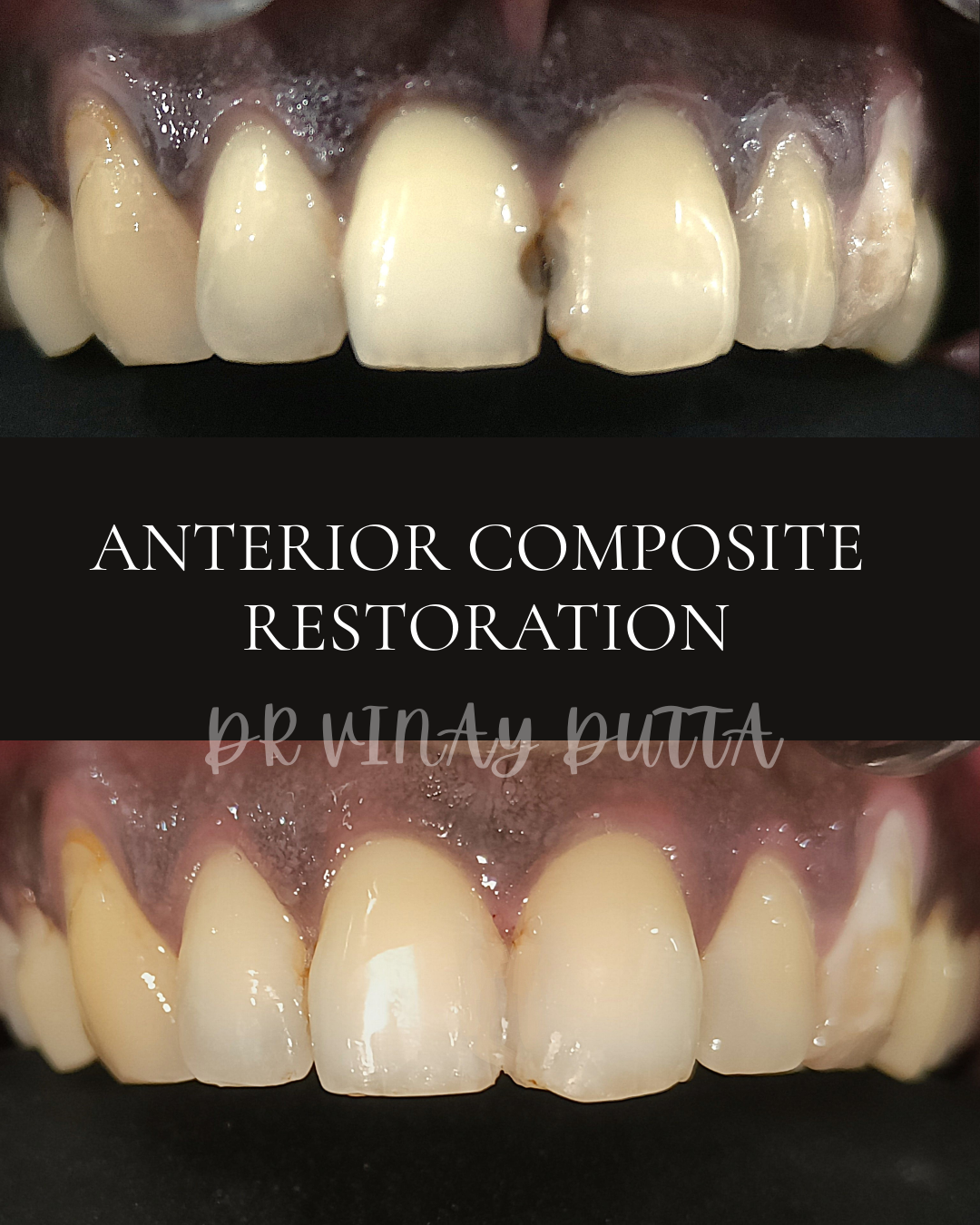 Anterior Composite Restoration Booking