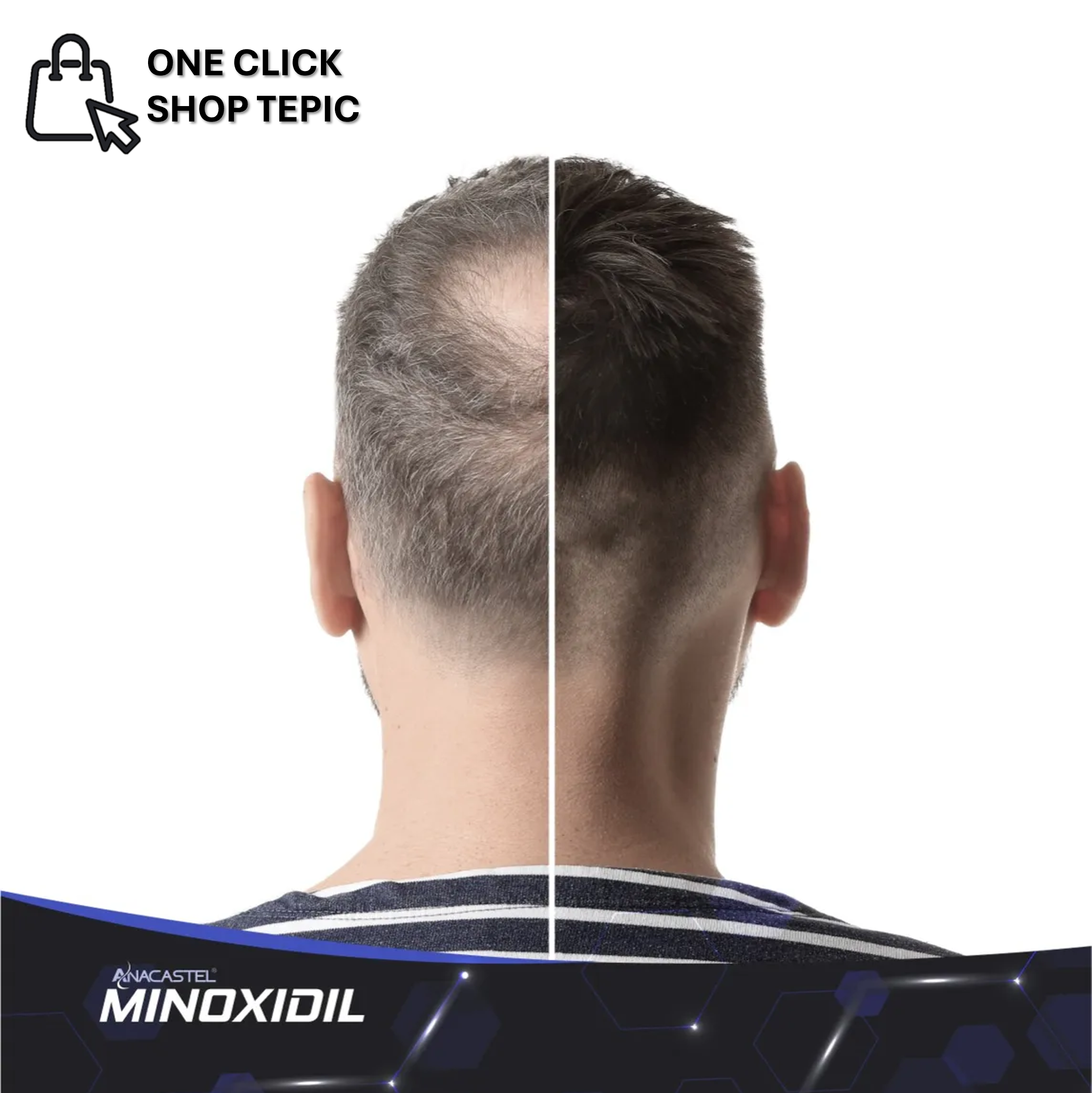 Minoxidil Anacastel 5% Solución Cabello Y Barba 60 Ml