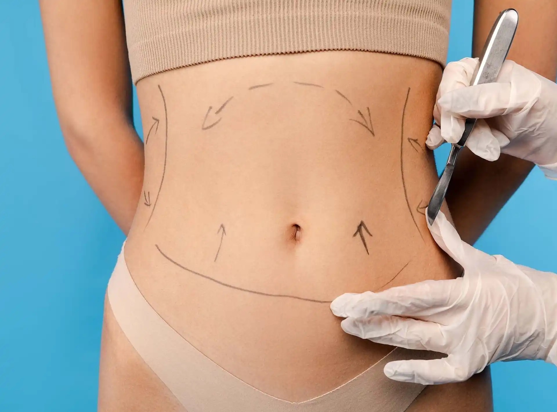 Liposuction