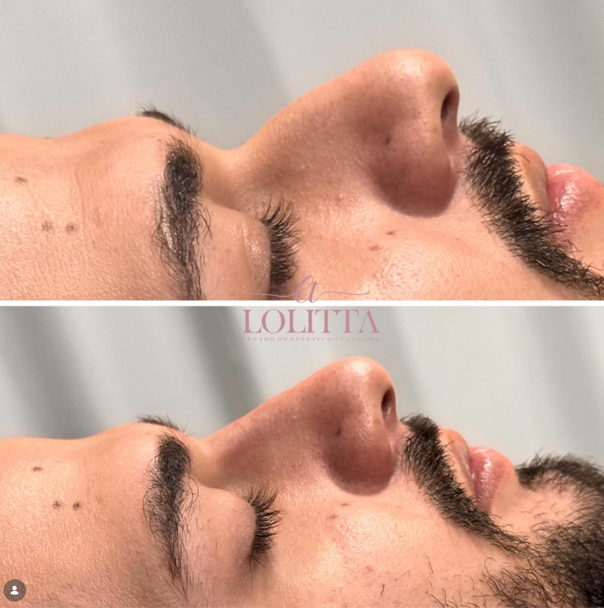 Rinomodelação Masculina