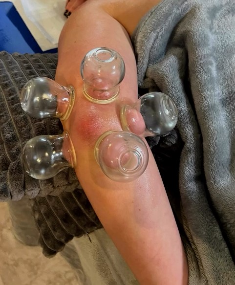 Terapia stawów bańkami