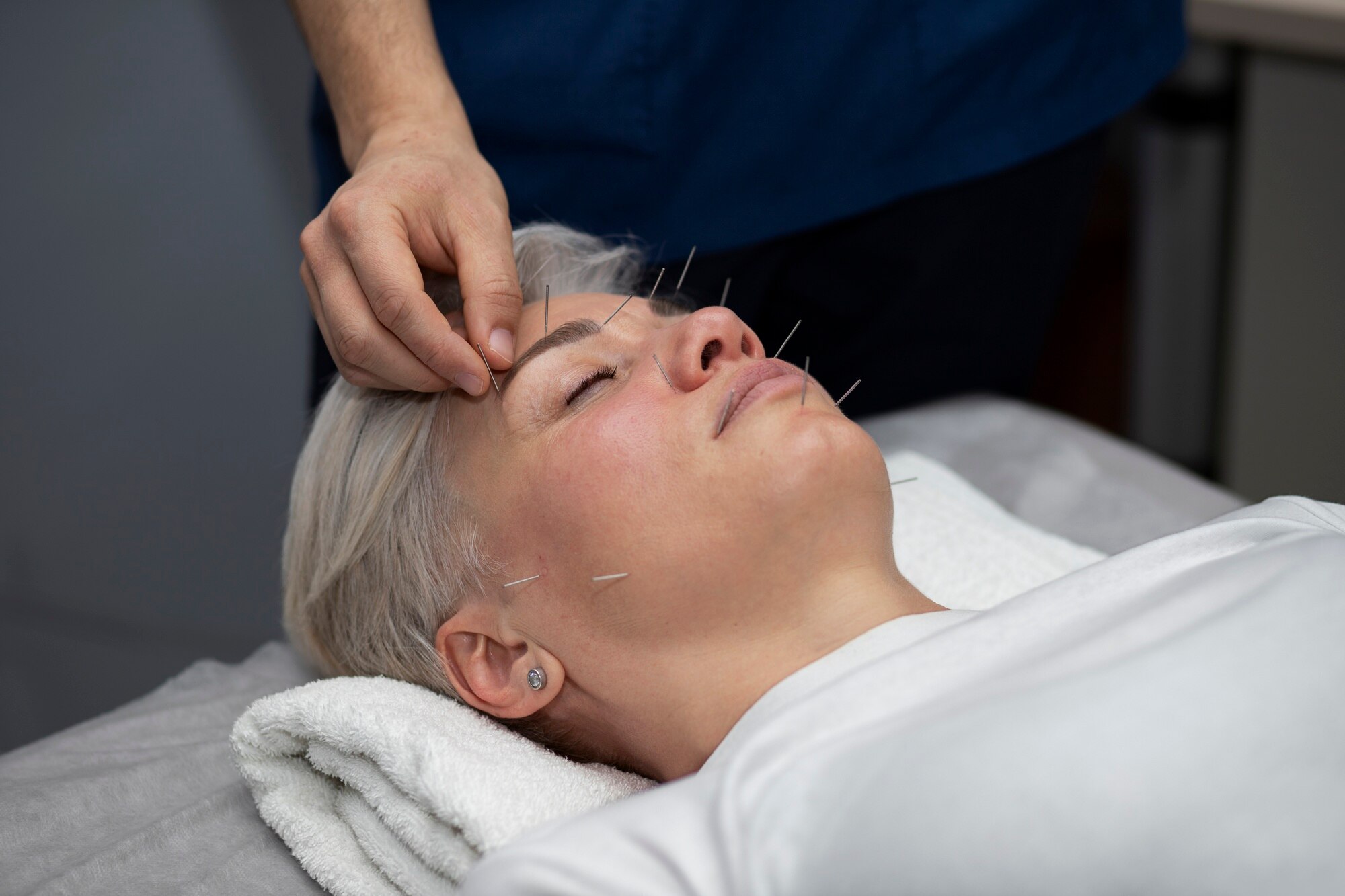 Initial Cosmetic Acupuncture Session
