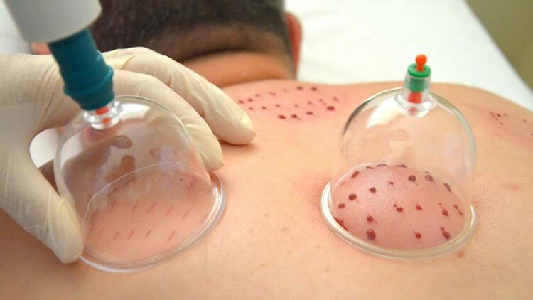 Hijama (Wet Cupping) Therapy Booking