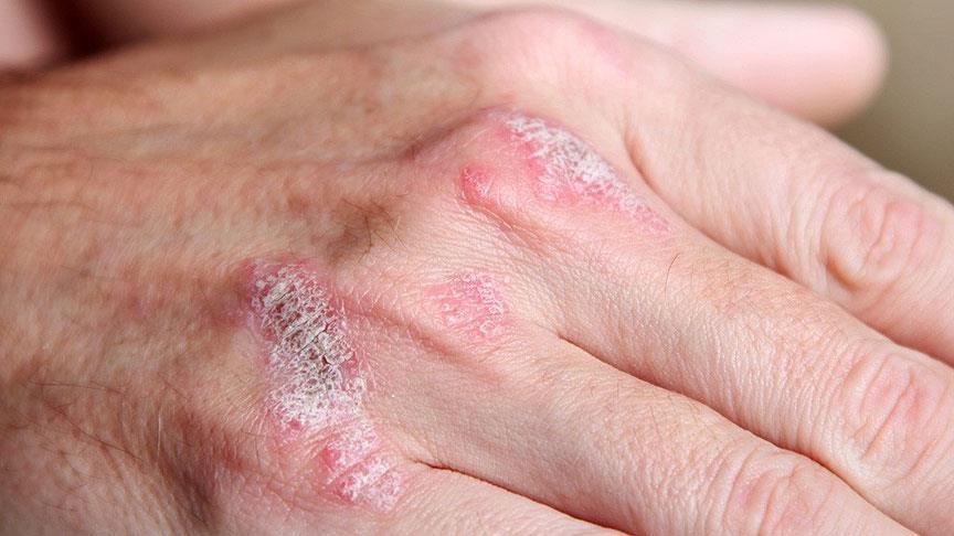 Sedef (psoriasis)