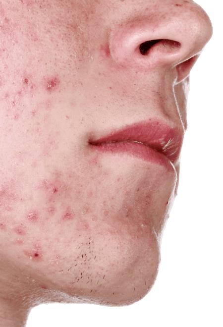Akne(Sivilce)