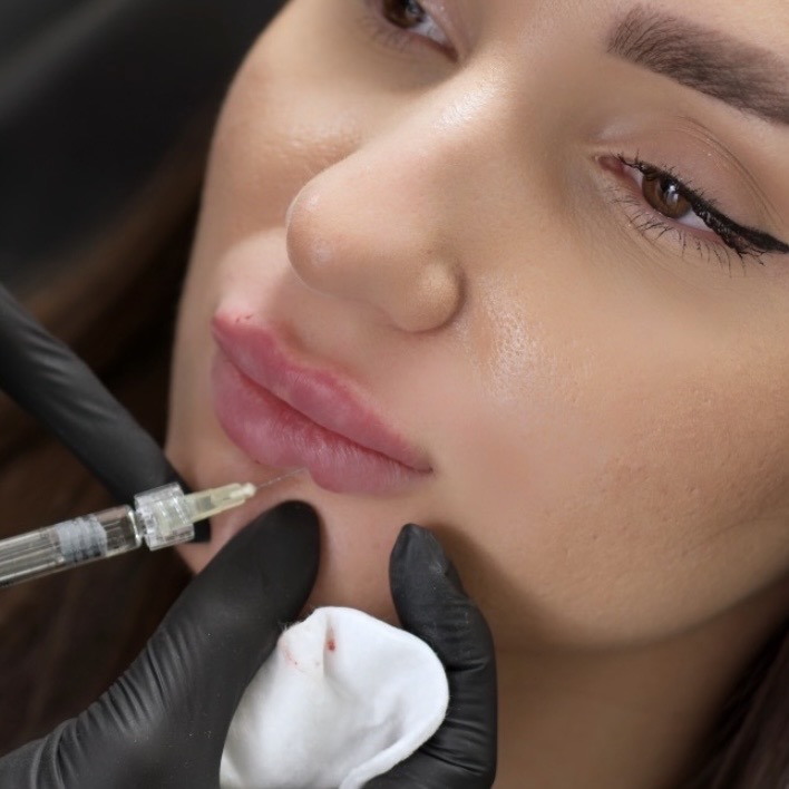 Lip Fillers Half Syringe 