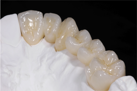 Zirconia Crown