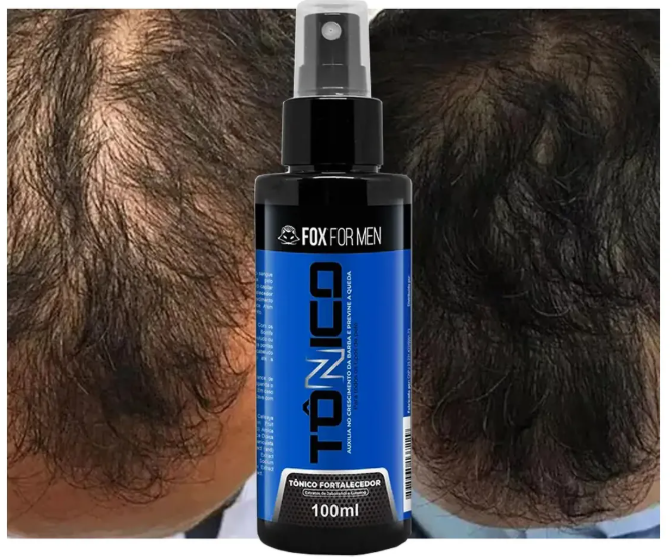 Minoxidil
