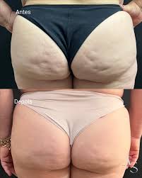 Detox Estético 7 Dias