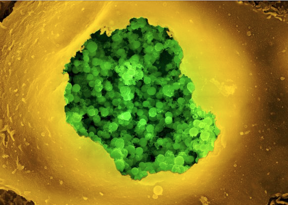 Chronic Infection Screening