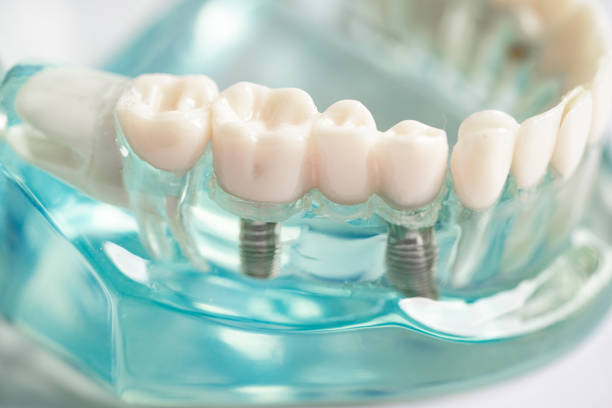 Dental Implant