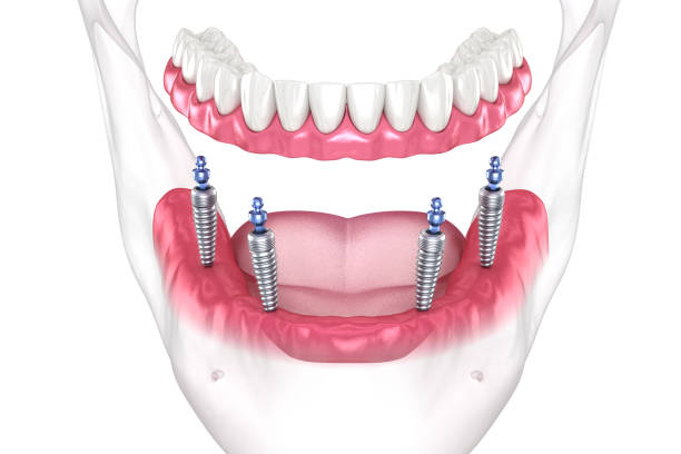 Dental Implant