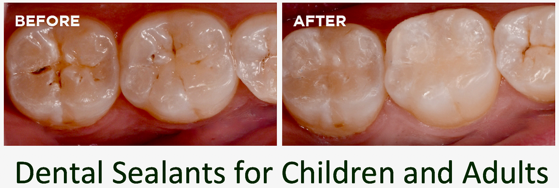 Dental Sealant Application