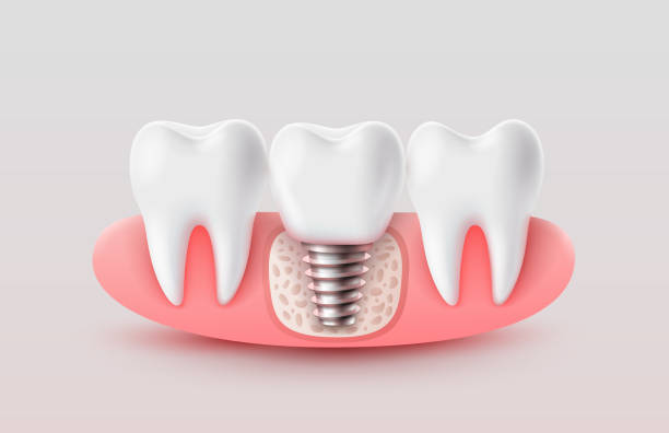 Dental Implant