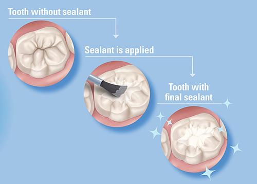 Dental Sealant Application