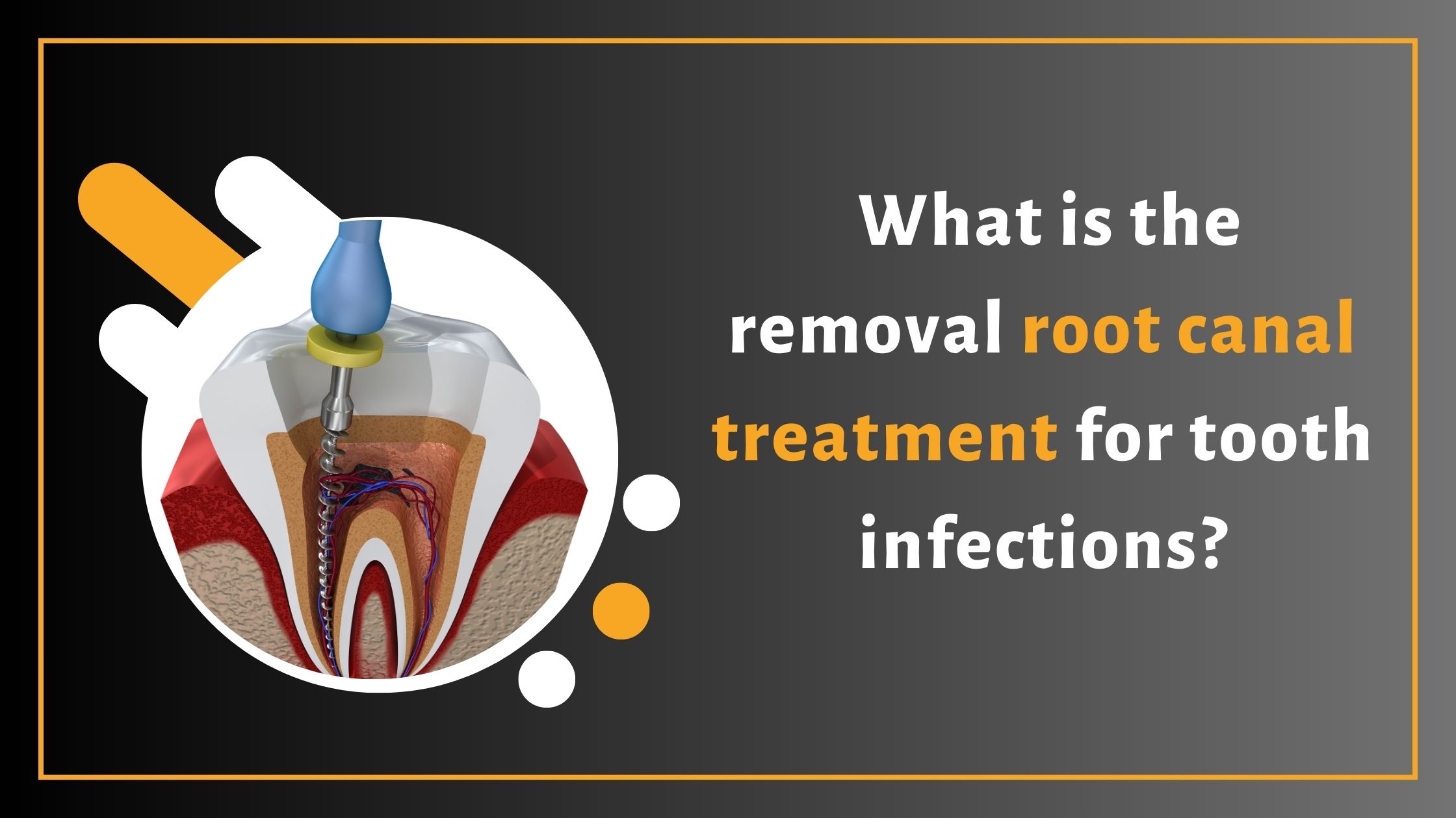 Root Canal Treatment (RCT)