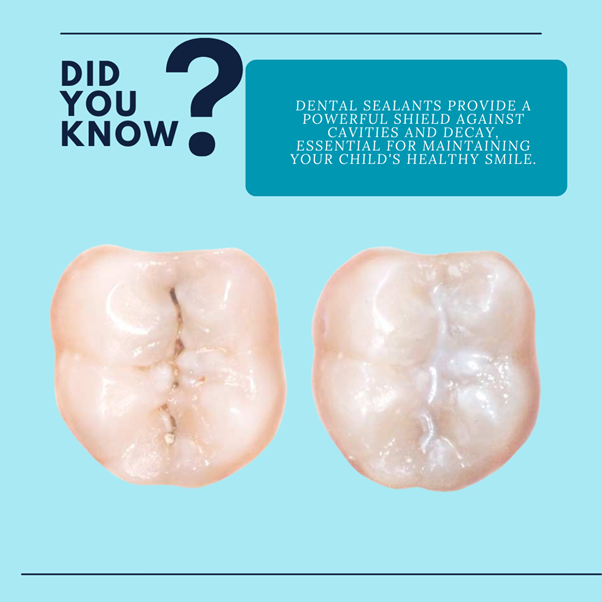 Dental Sealant Application