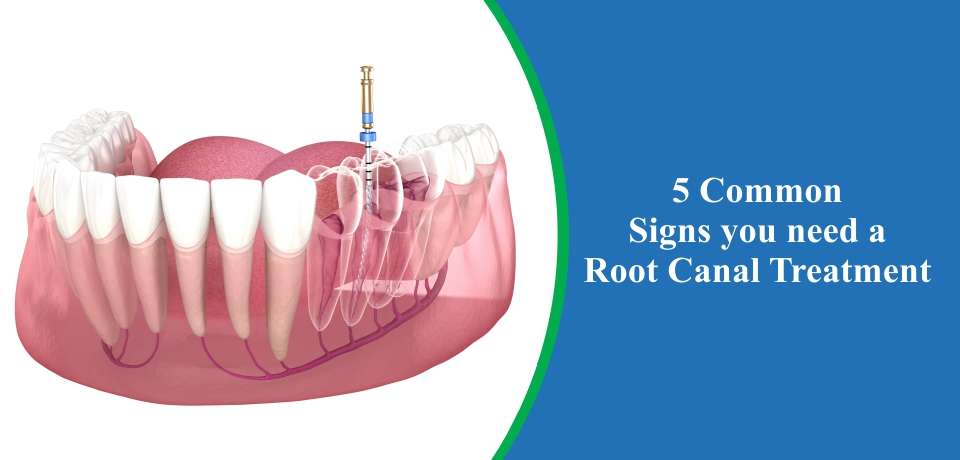 Root Canal Treatment (RCT)