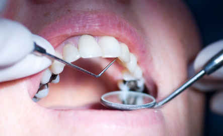 Routine Dental Check-ups