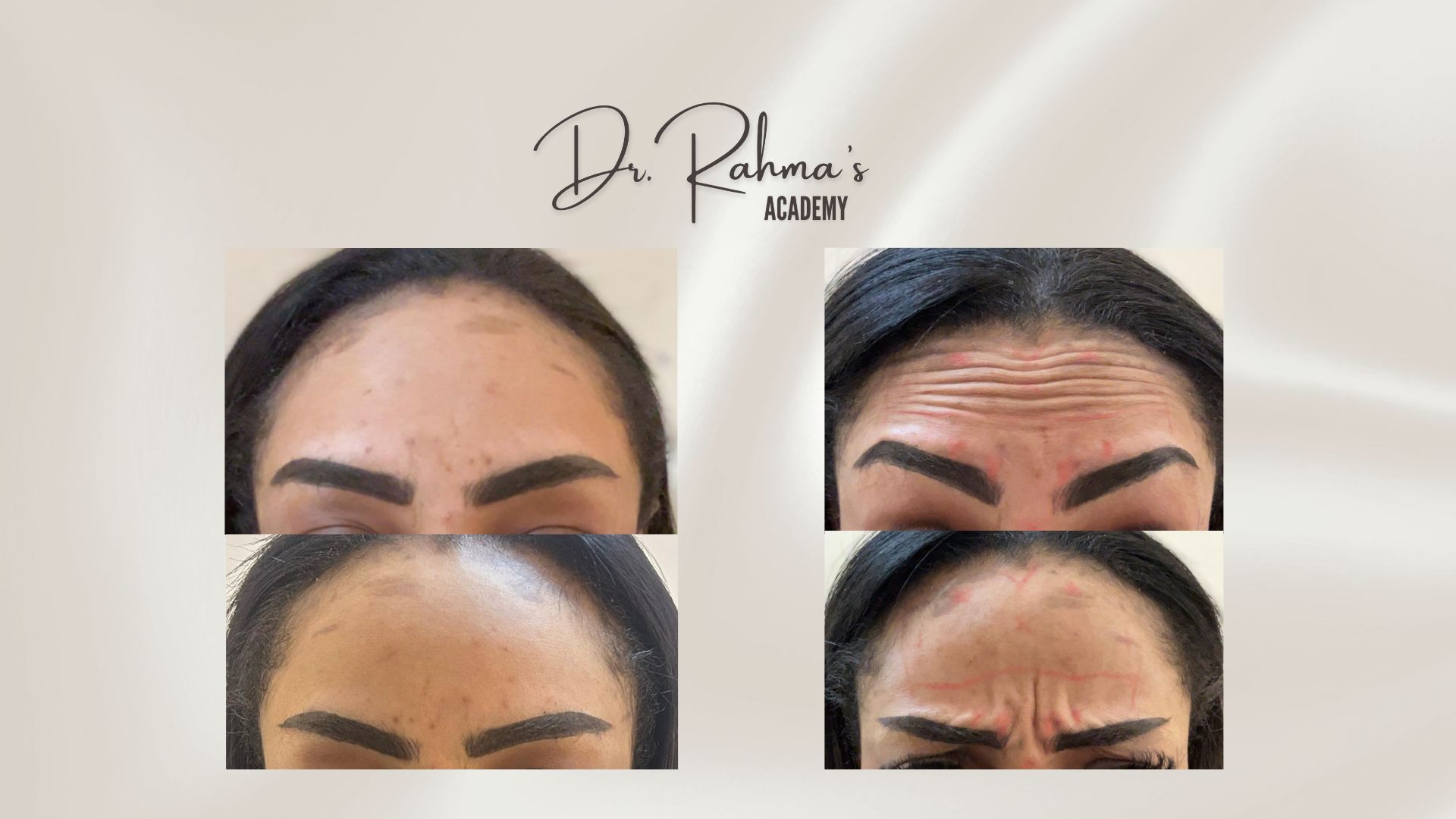 Botox