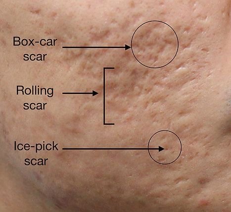 Subcision