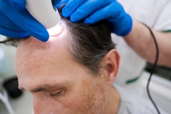 Evaluación de Caída del Cabello