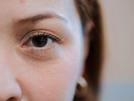 Tratamientos para Ojeras