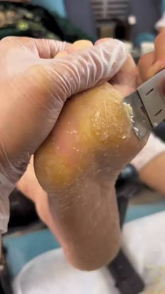 Callus Removal Session