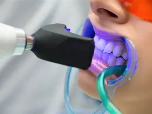 Bleaching for Whitening of Teeth 