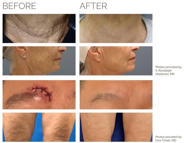 Classic Microneedling: Collagen Induction Therapy
