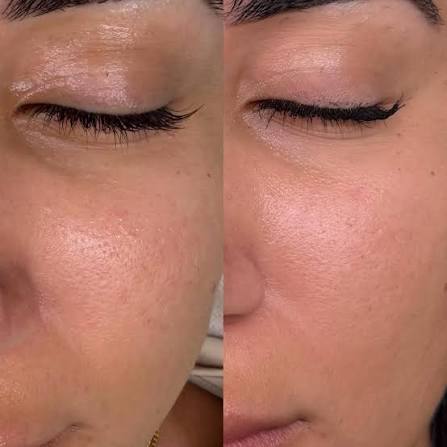 Nano Needling: The Ultimate No-Downtime Glow & Infusion