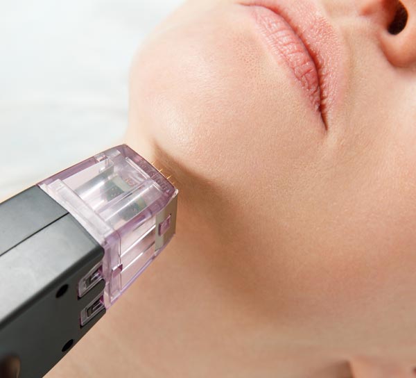 RF Microneedling: Collagen Remodeling & Scar Smoothing