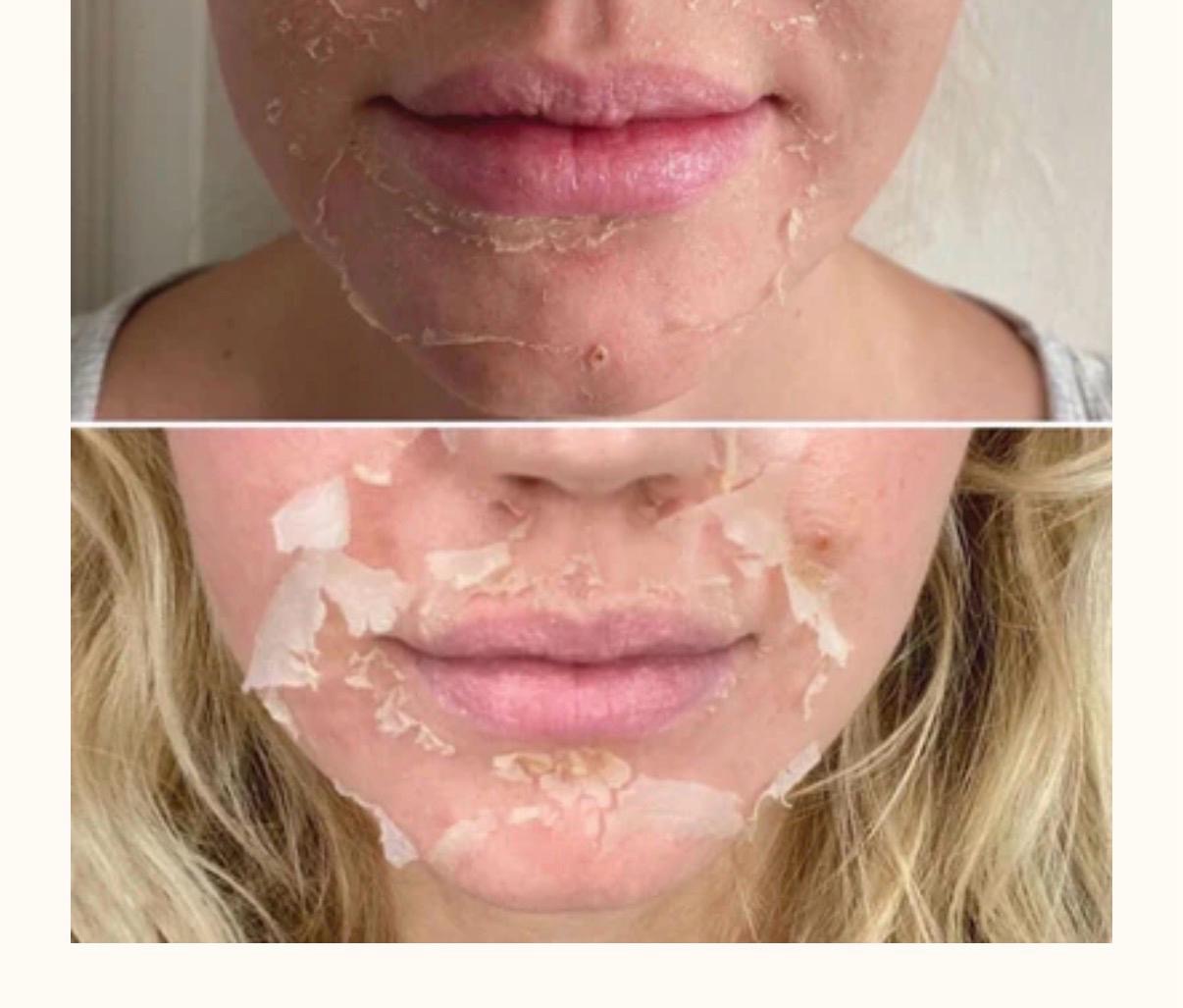 VI CHEMICAL PEEL