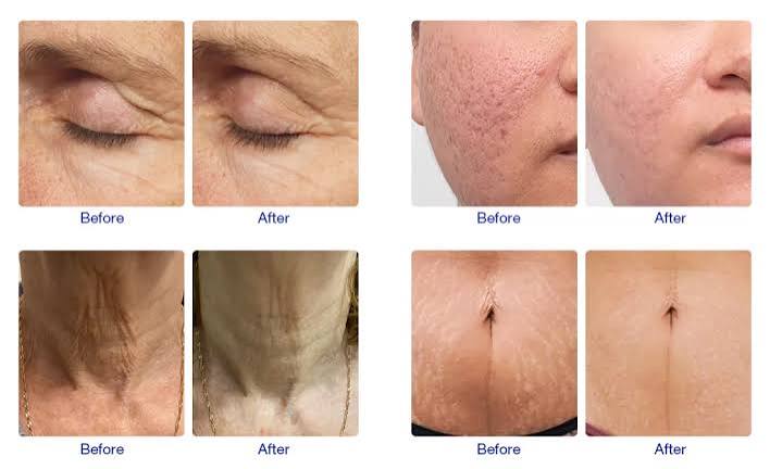 RF Microneedling: Collagen Remodeling & Scar Smoothing